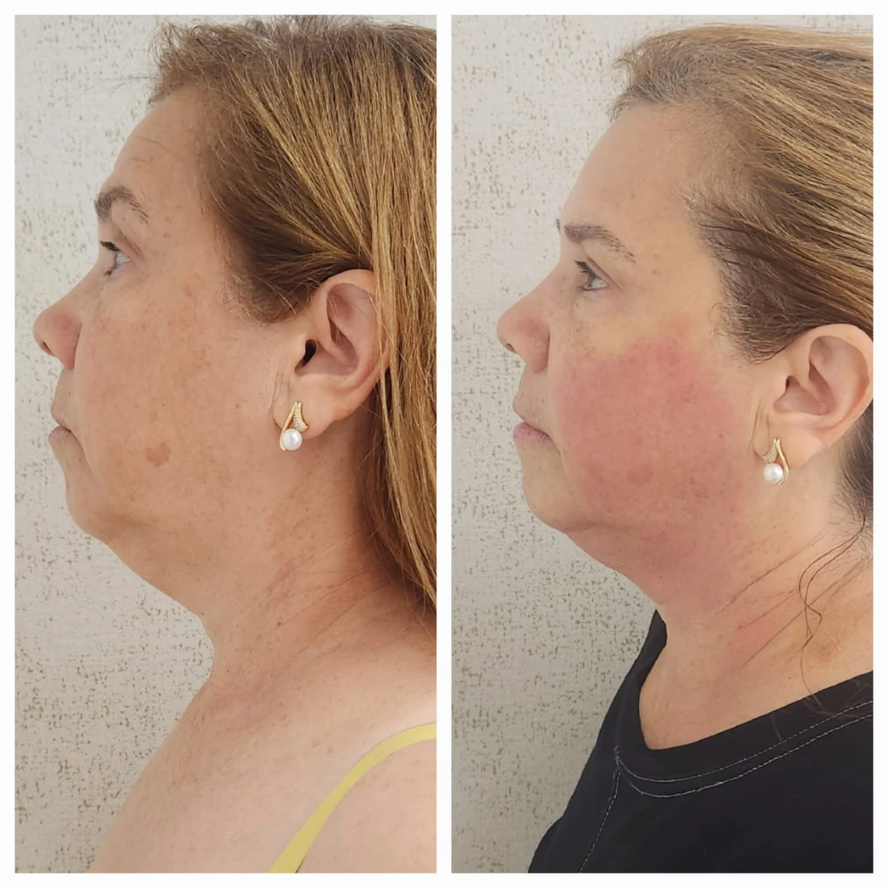 Comparação de atendimento facial — vista de perfil