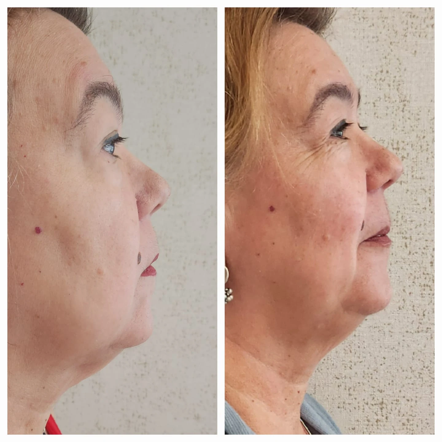 Comparação de atendimento facial — contorno em perfil