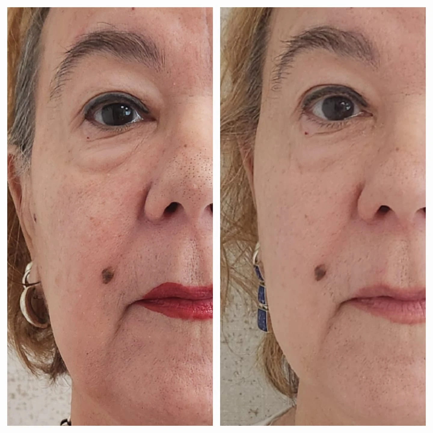 Comparação de atendimento facial — rosto e região dos olhos