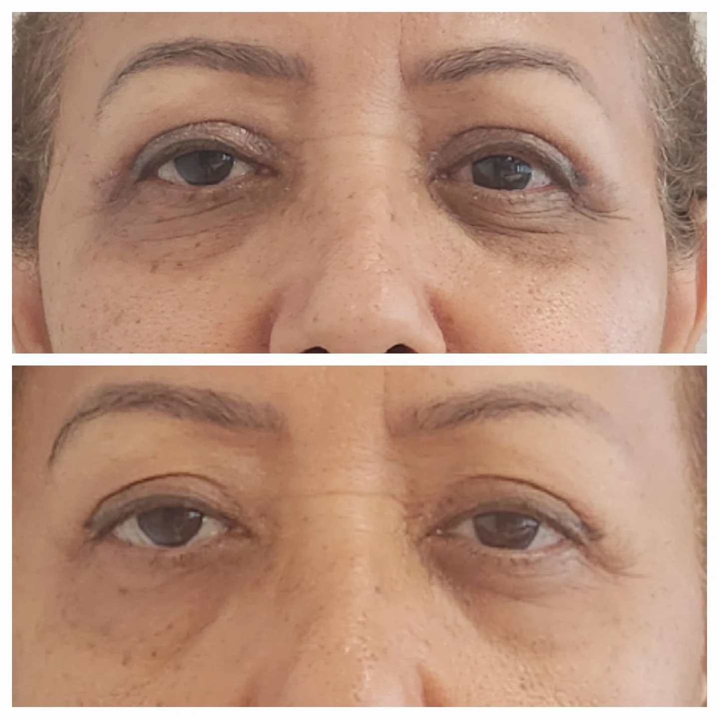Comparação de atendimento facial — região dos olhos
