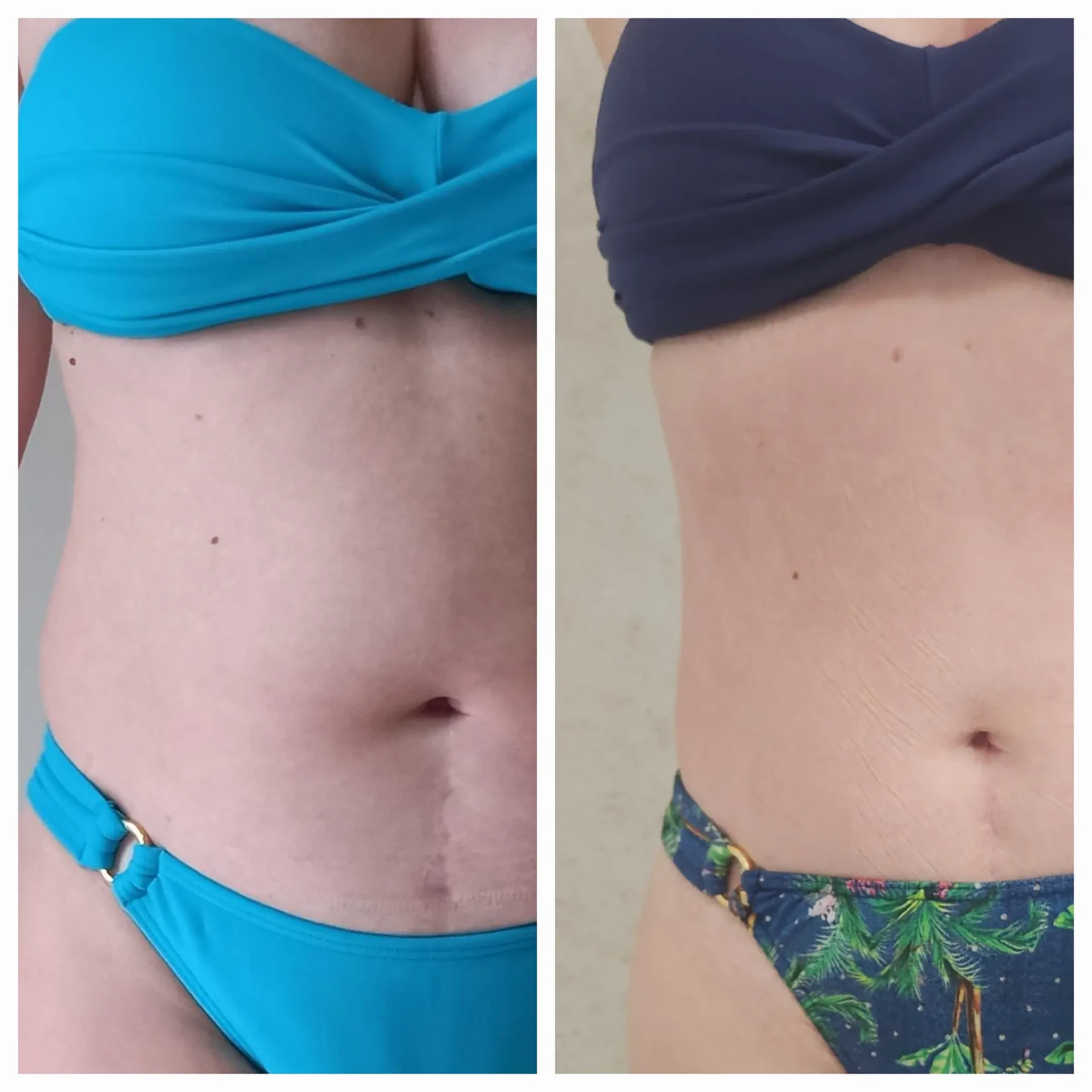 Antes e depois do Sculpt 360 — abdômen — vista frontal