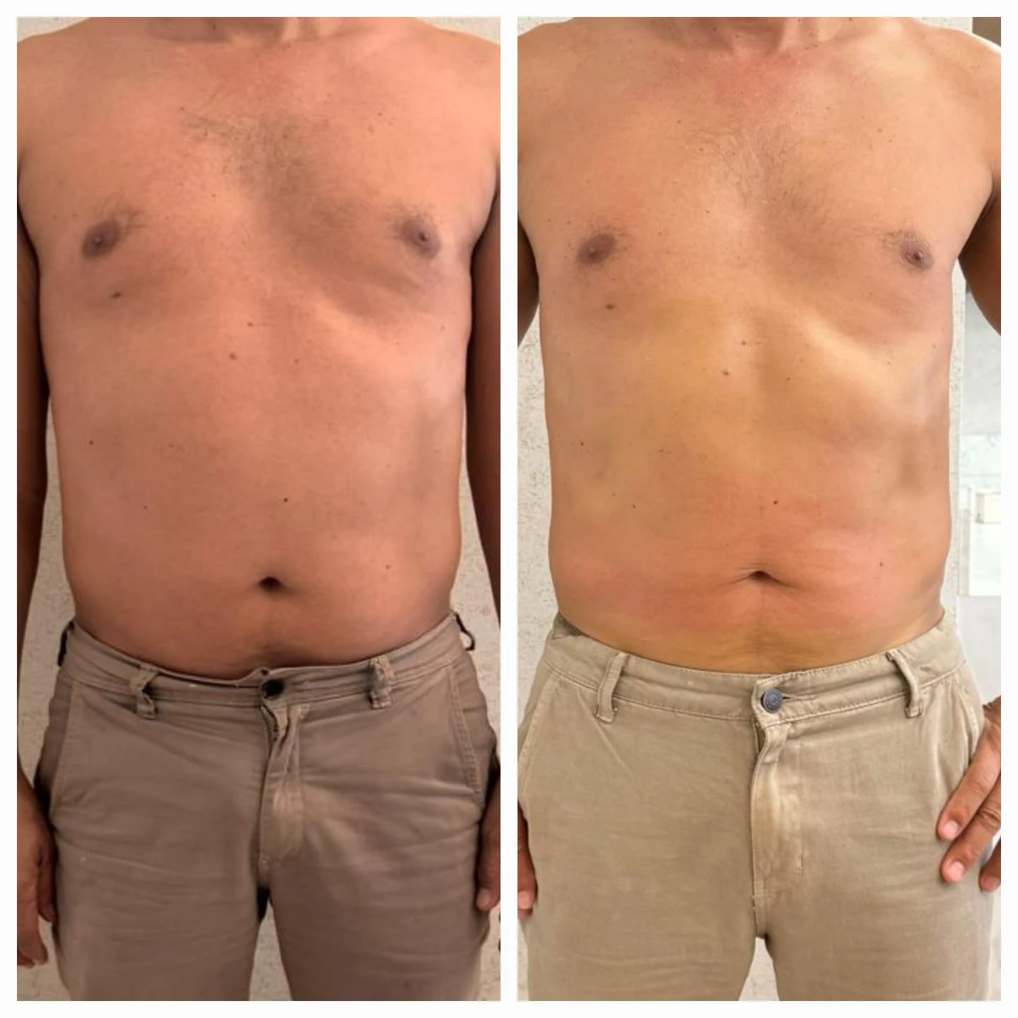 Antes e depois do Sculpt 360 — abdômen — atendimento masculino