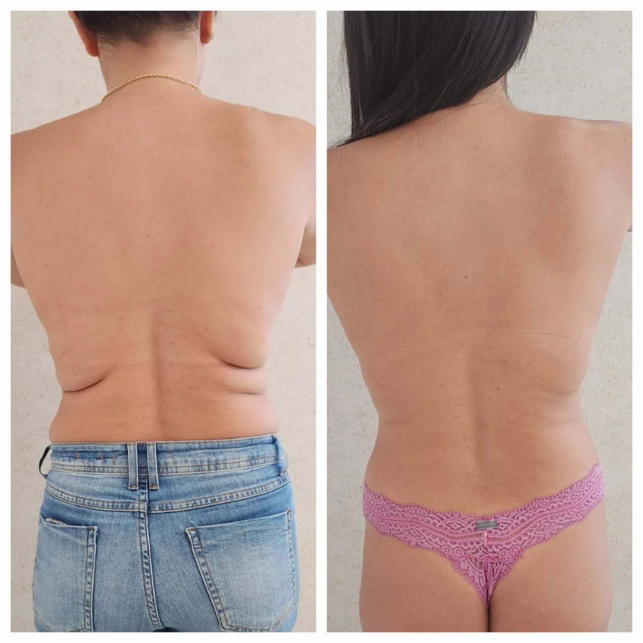Antes e depois do Sculpt 360 — costas e flancos