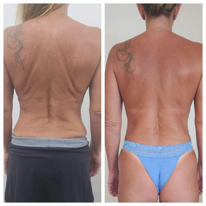 Antes e depois do Sculpt 360 — costas